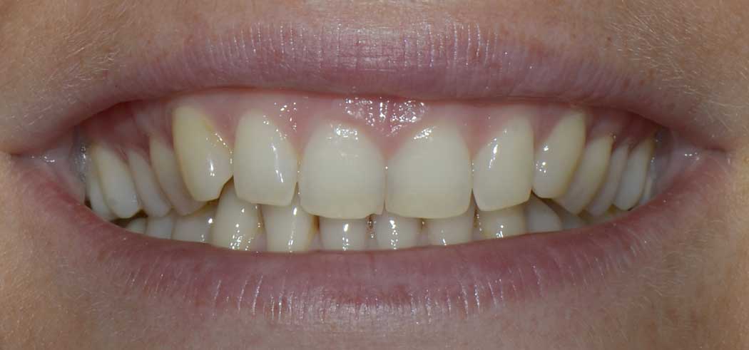 cas_clinique_no_prep