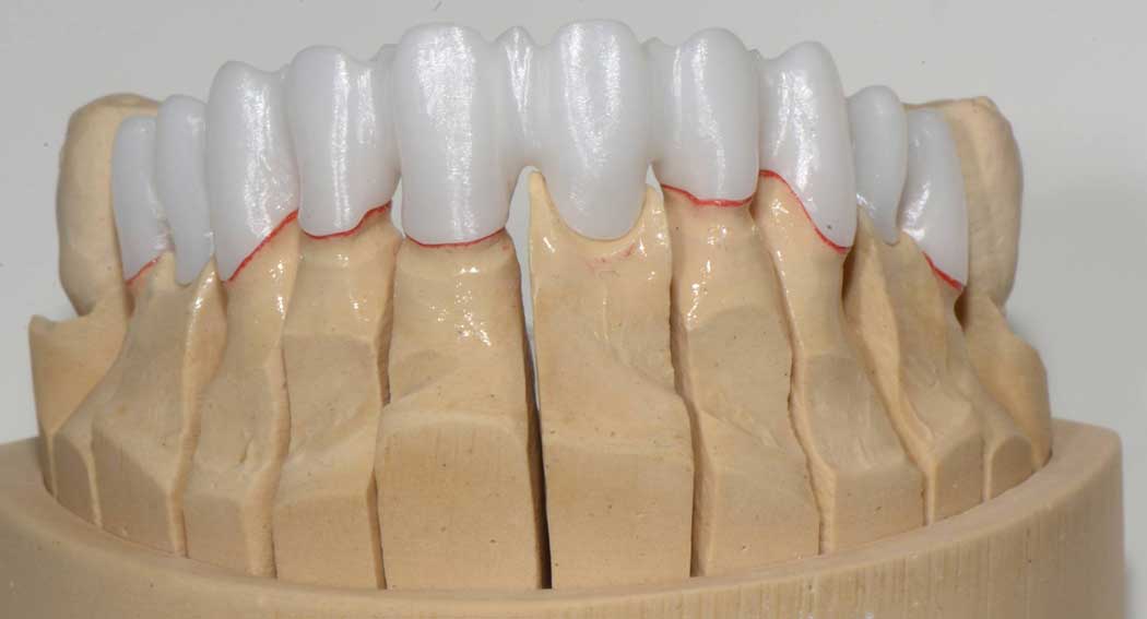 armature en zircone